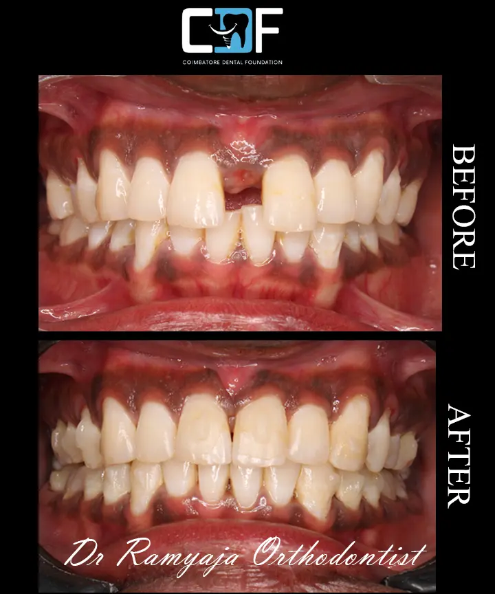 Dhaya Invisalign Intraoral